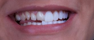 Veneers pros and cons