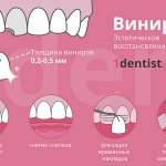 Виниры вместо имплантов