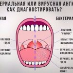 Вирусная и бактериальная ангина