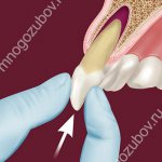 Vital tooth replantation