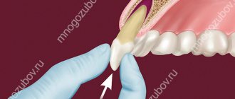 Vital tooth replantation