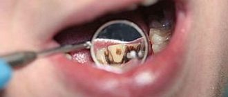 external discoloration of teeth