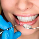 Intra-canal whitening - Smile Line Dentistry