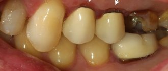 inflammation of the gums under old crowns, poor fit