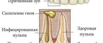 воспаление десны