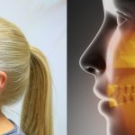 Inflammation of the TMJ