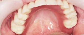 The palate in the mouth is inflamed near the teeth, how to treat it