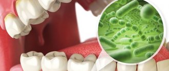 Восстановление микрофлоры полости рта. Диагностика и лечение дисбактериоза