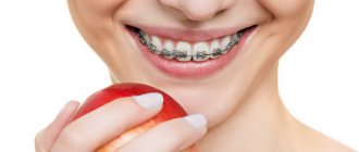 Choosing braces. Which systems are better to install? 