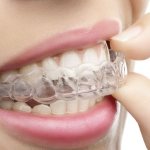 Teeth straightening with aligners