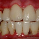 Ulcerative-necrotizing gingivitis