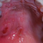 ulcers on the roof of the mouth