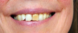 Yellow stain on teeth