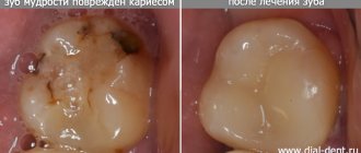 wisdom tooth before and after treatment