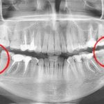 The wisdom tooth is not fully formed