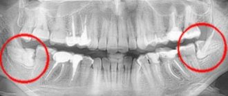 The wisdom tooth is not fully formed