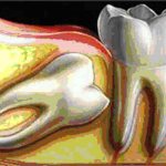 wisdom tooth