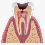 Зуб пораженный кариесом
