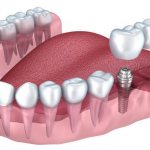 Dental bridge on implants