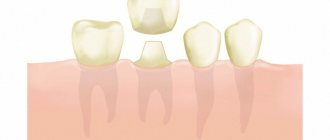 Dental crowns